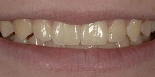 32211 lafayette teeth whitening consultation