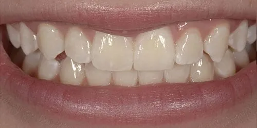 32211 lafayette teeth whitening process