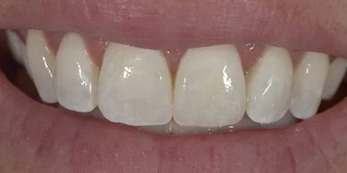 /img/32211-lafayette-teeth-whitening-provider.webp