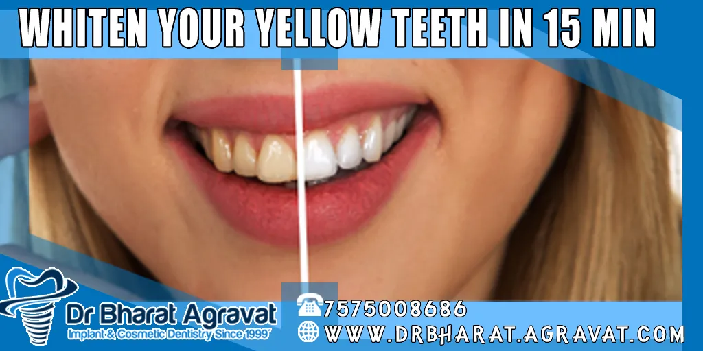 32213 at home whitening kits