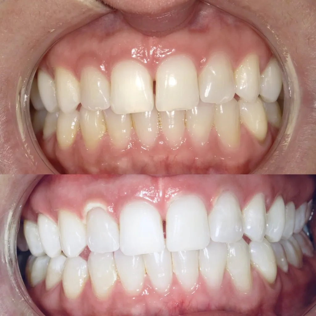 /img/32214-ny-teeth-whitening-youthful.webp