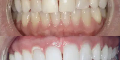 /img/32214-ny-teeth-whitening-youthful.webp