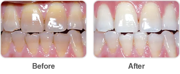 32216 led light teeth