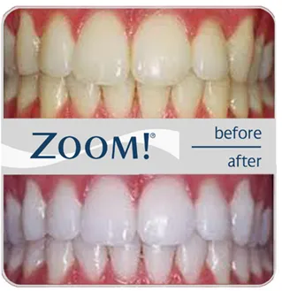 32217 teeth whitening results