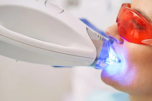 32219 professional teeth whitening