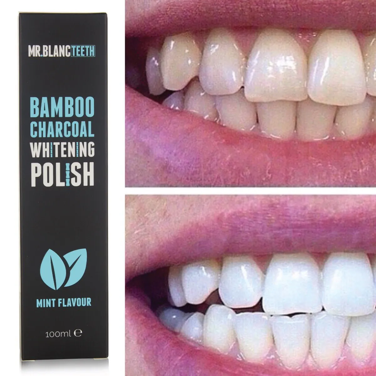 32226 applying whitening gel