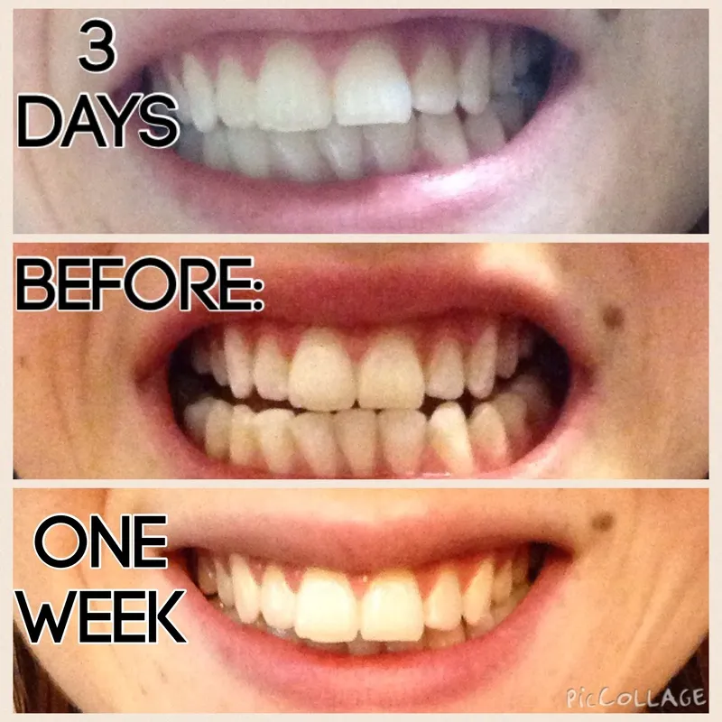 32226 teeth after whitening