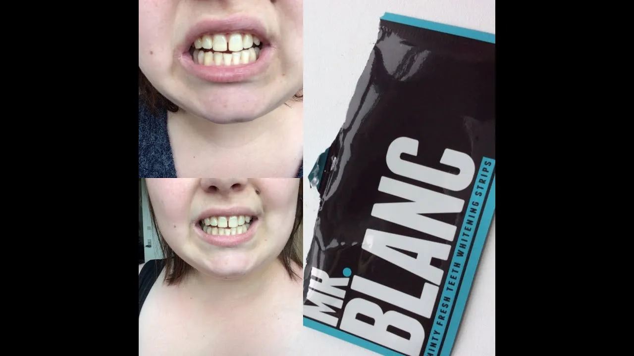 32226 teeth before whitening