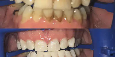 /img/32227-healthy-smile-teeth.webp
