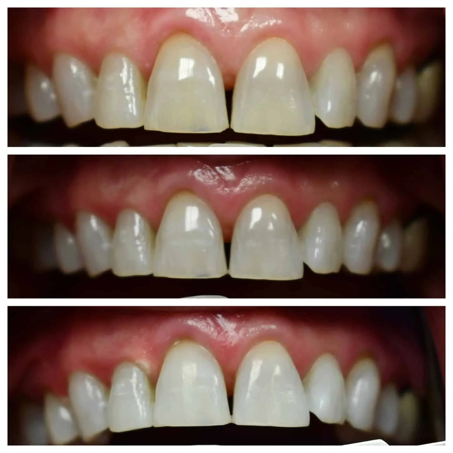 32228 teeth whitening nashville professional
