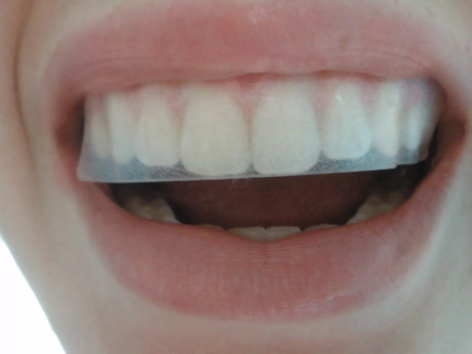 32237 platinum whitening kit cvs application