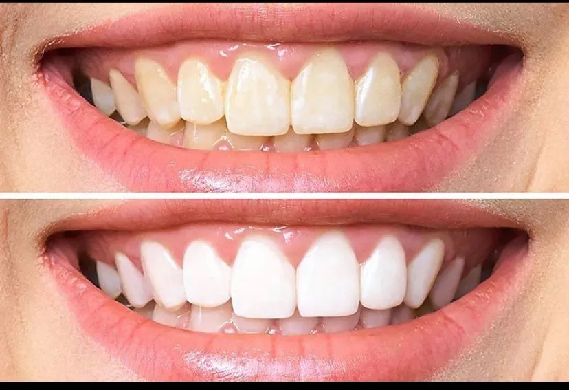 32249 maintaining bright smile