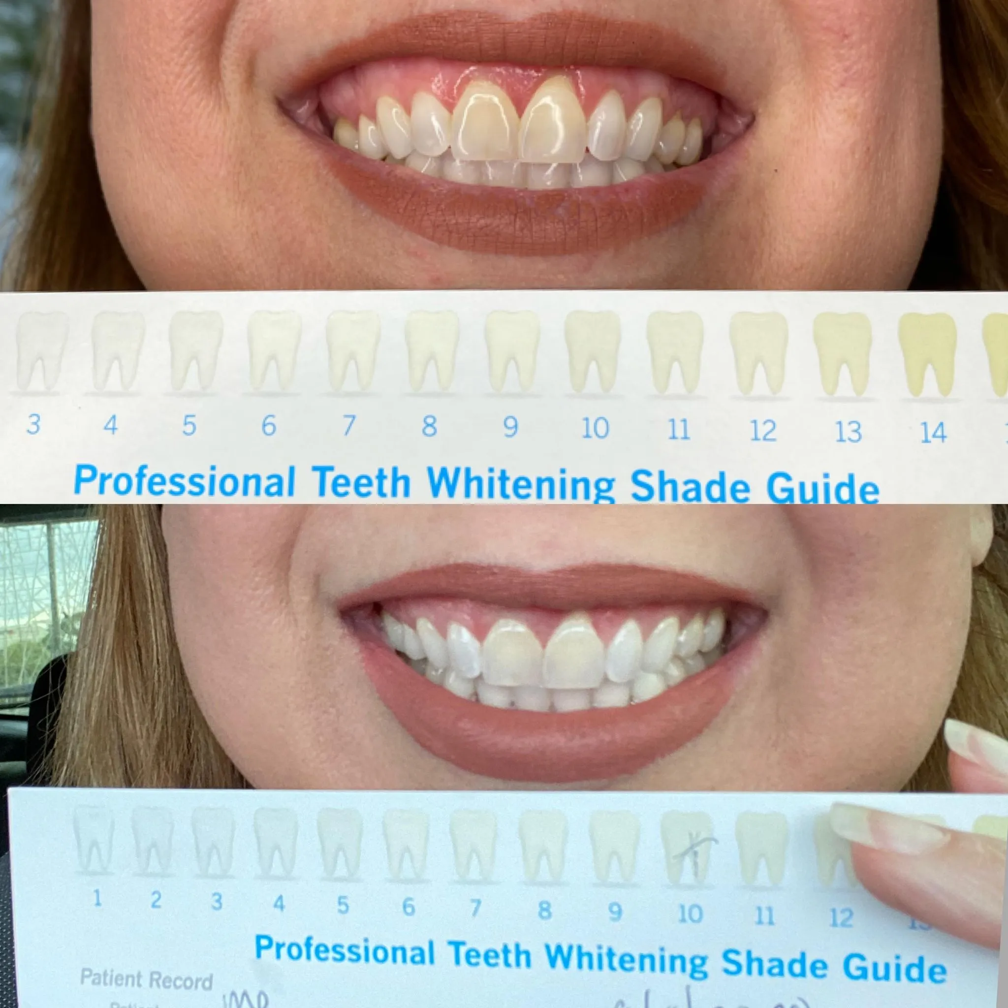 32249 top 5 houston whitening options