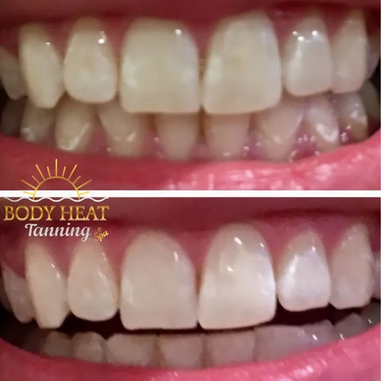 /img/32254-at-home-whitening-kits.webp