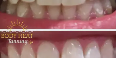 /img/32254-at-home-whitening-kits.webp