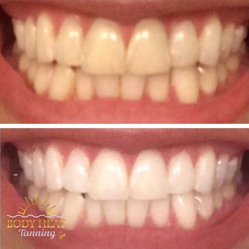 32254 professional dental whitening