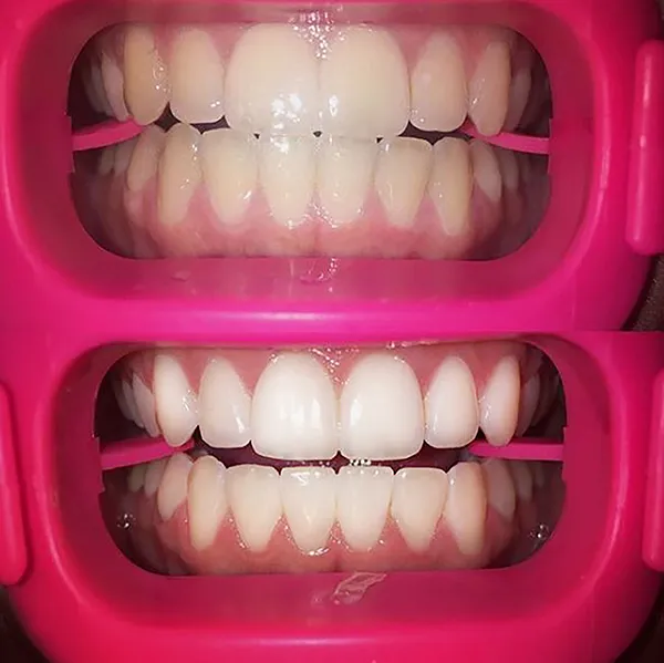 32254 teeth whitening tanning salons risk4