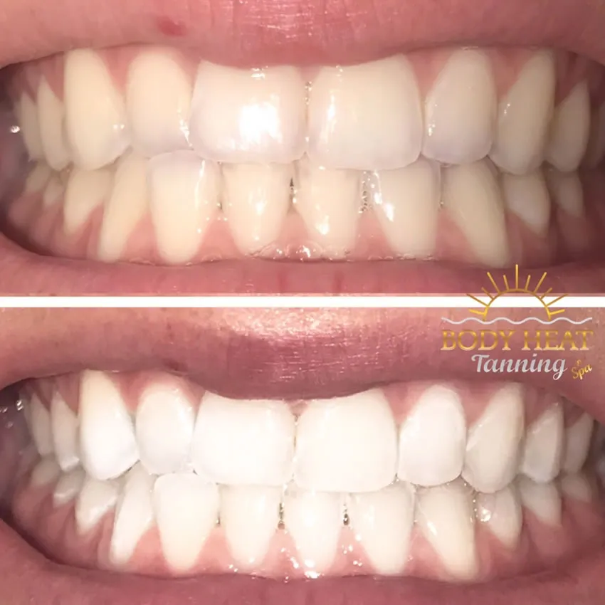 32254 teeth whitening tanning salons risk5