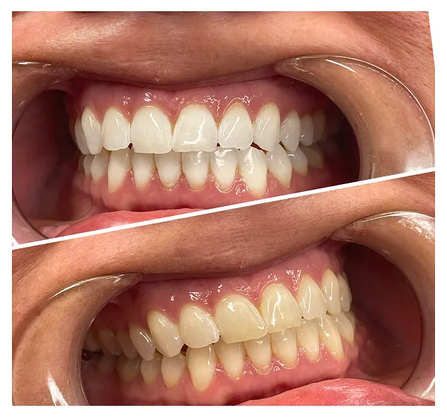 32255 choosing teeth whitening