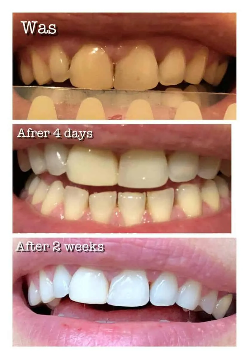 32257 snow teeth whitening results