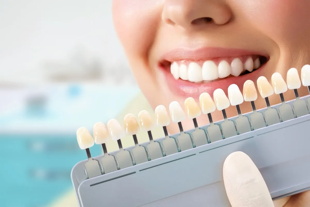 32259 teeth whitening adelaide before after