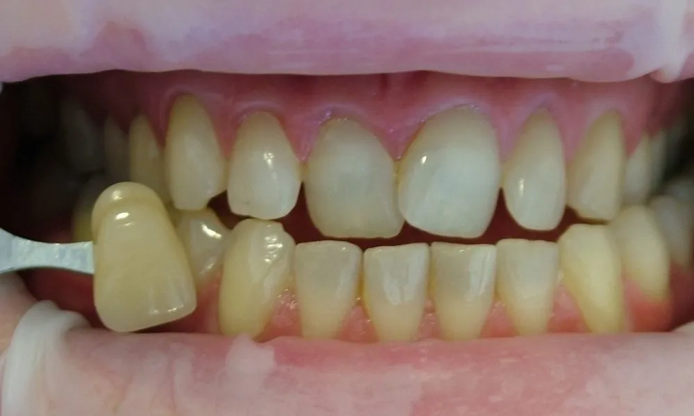 /img/32259-teeth-whitening-adelaide-food-stains.webp