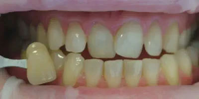 /img/32259-teeth-whitening-adelaide-food-stains.webp