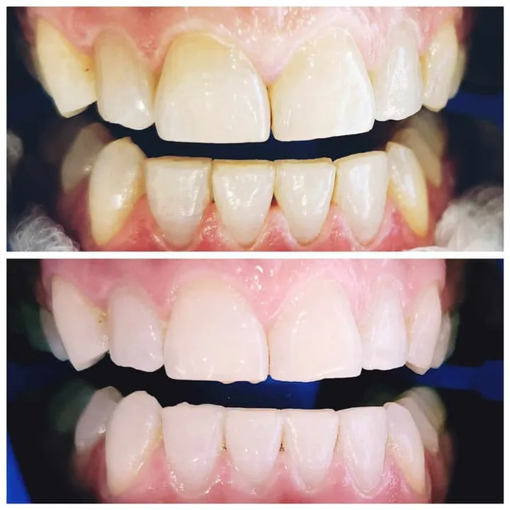 32259 teeth whitening adelaide healthy teeth