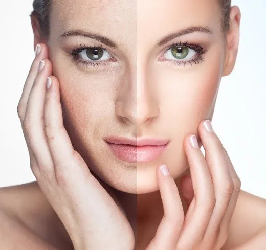 32262 chemical peel face