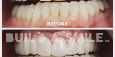 /img/32263-teeth-whitening-nc-results.webp