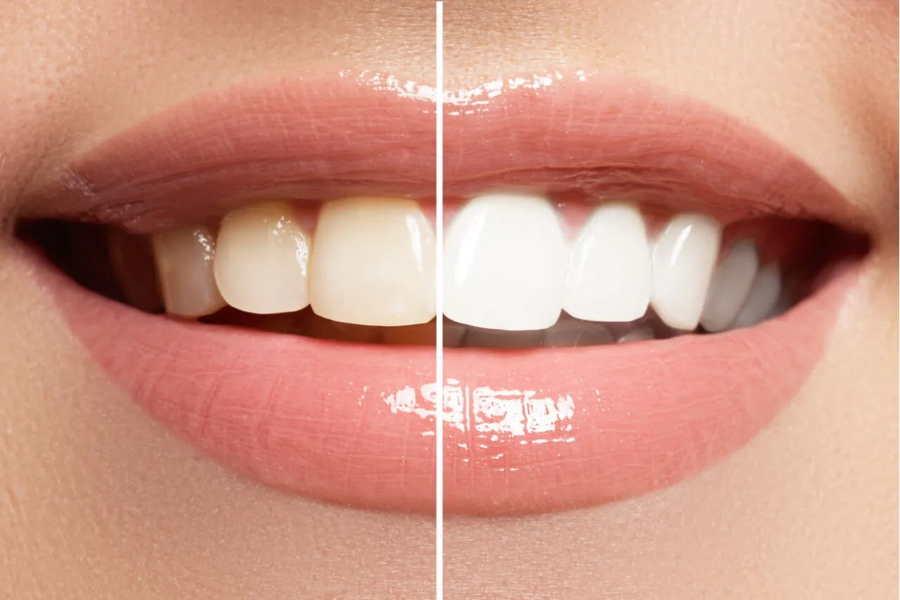 32265 teeth whitening kits