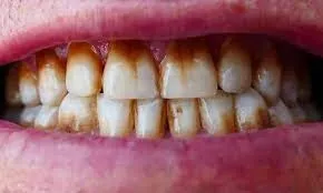 32265 teeth whitening problems