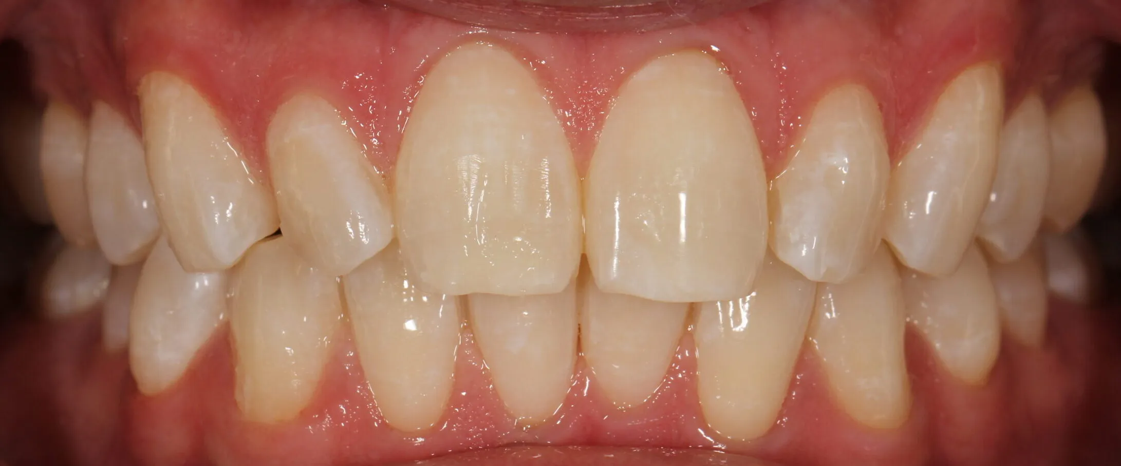 32265 teeth whitening professional