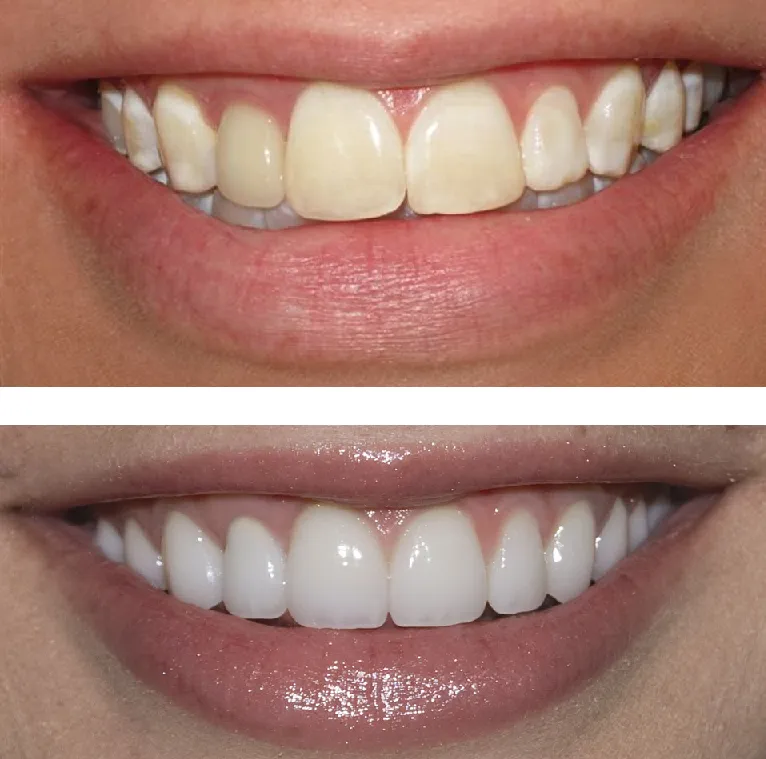 32265 teeth whitening strips