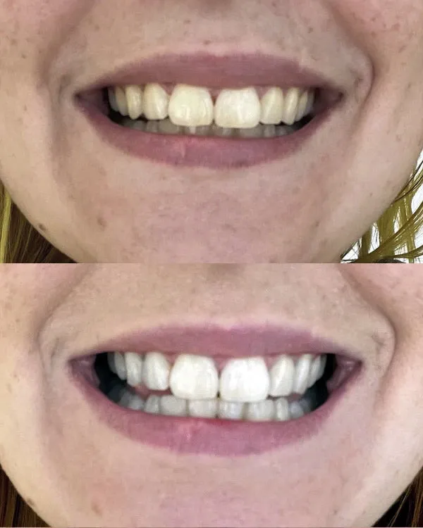 32266 professional teeth whitening