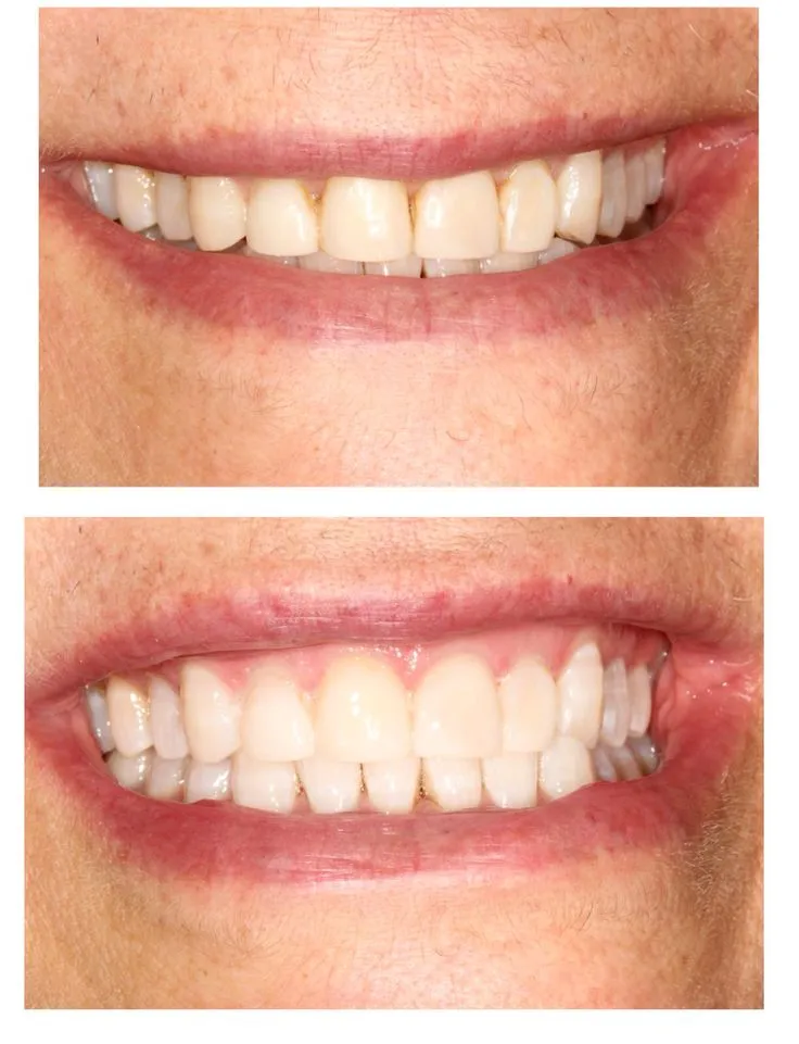 /img/32267-smiling-after-teeth-whitening.webp