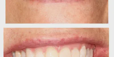 /img/32267-smiling-after-teeth-whitening.webp