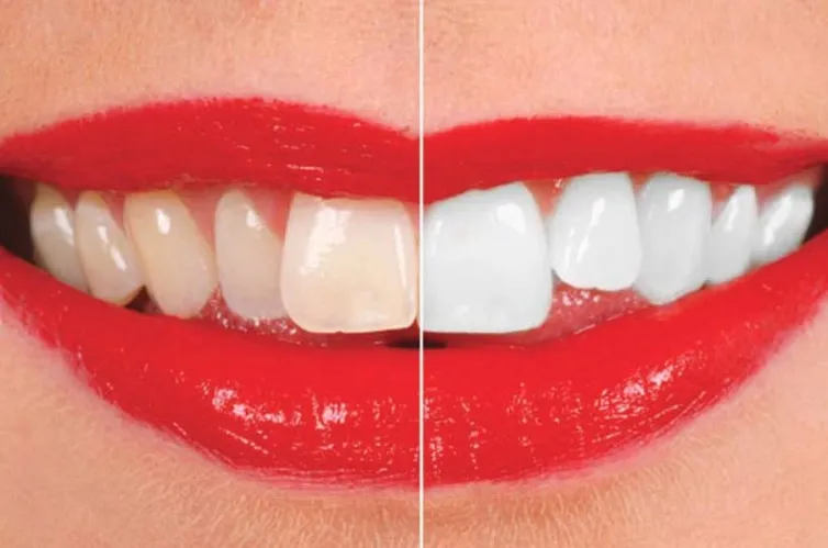 /img/32268-teeth-whitening-sydney-faq.webp