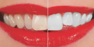 /img/32268-teeth-whitening-sydney-faq.webp