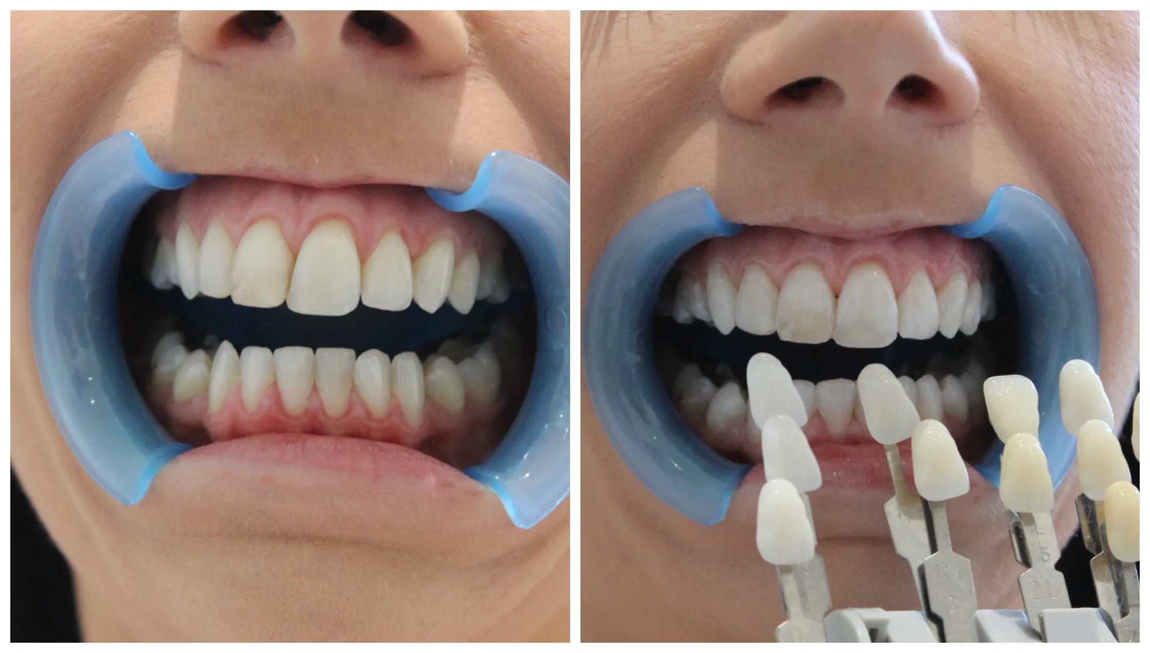 /img/32270-laser-skin-whitening-results.webp