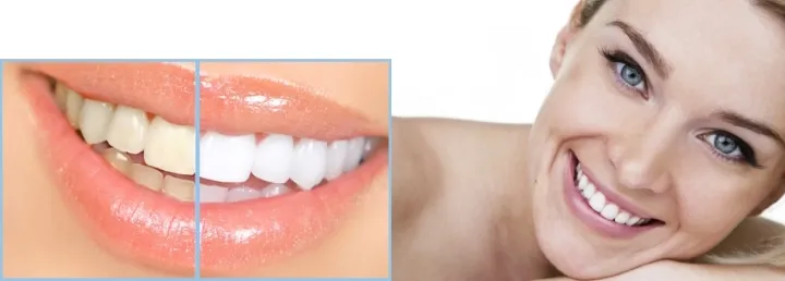 32273 at home teeth whitening