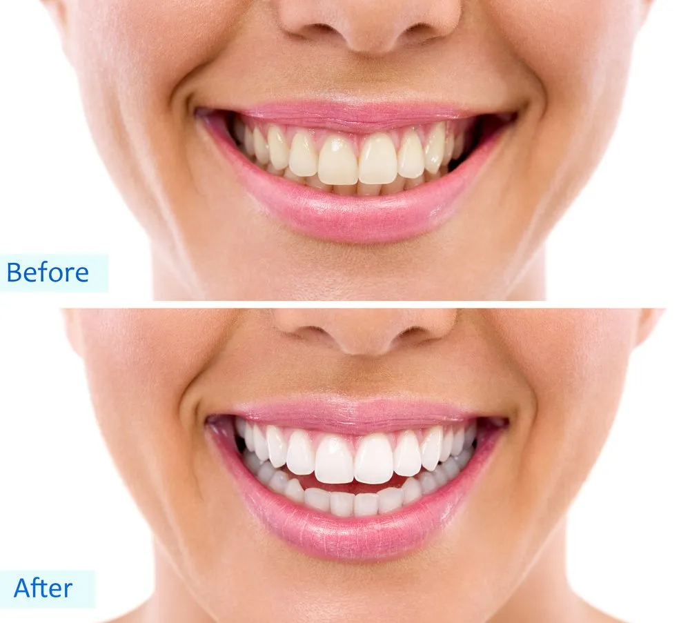 32274 in office teeth whitening