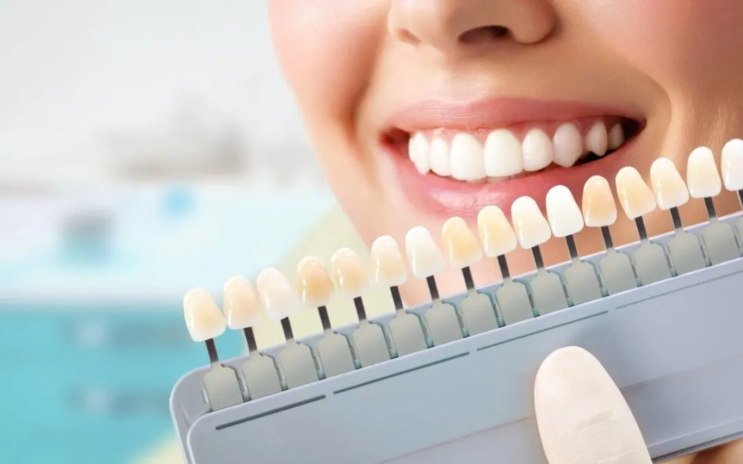 32274 teeth whitening cost factors
