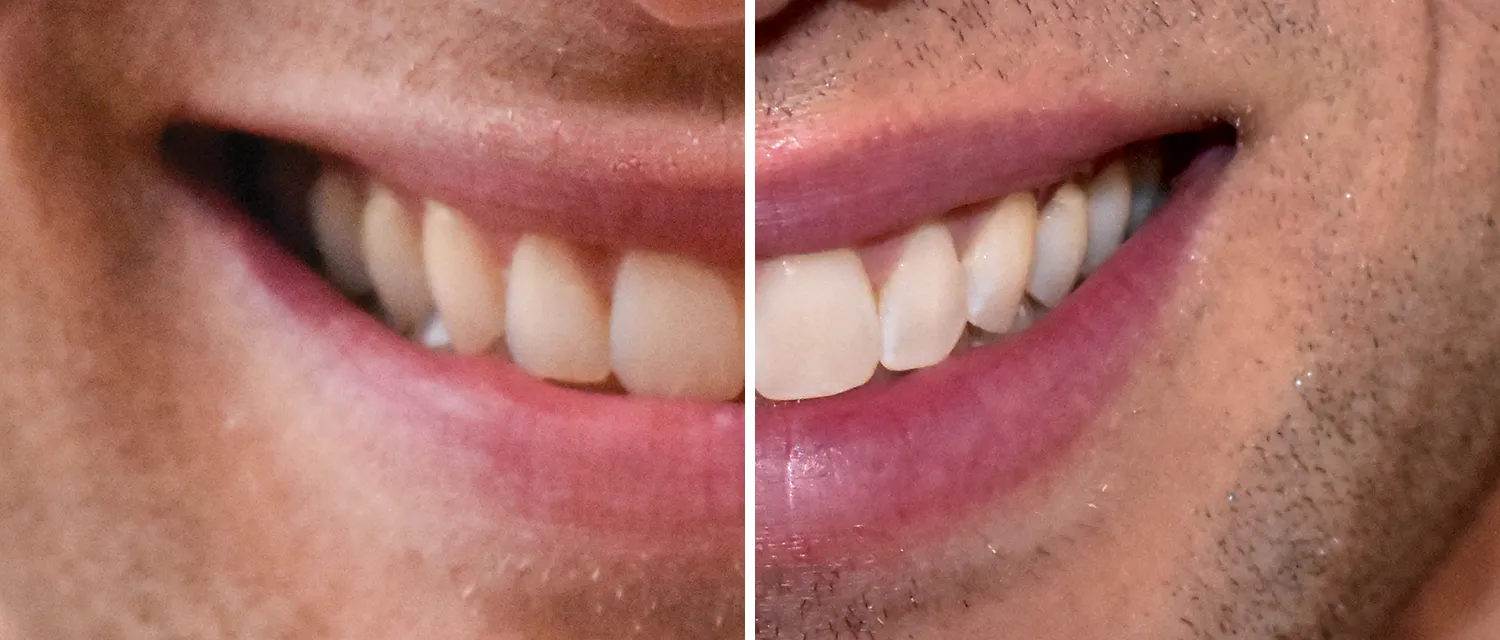 32275 uv teeth whitening 4