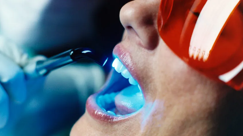 32275 uv teeth whitening 6