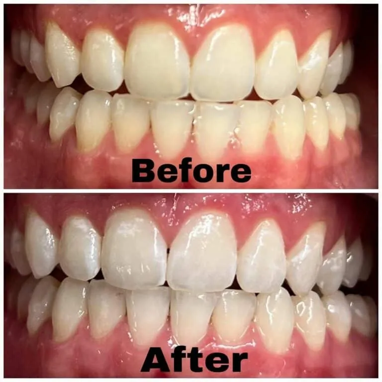 32284 teeth whitening aftercare