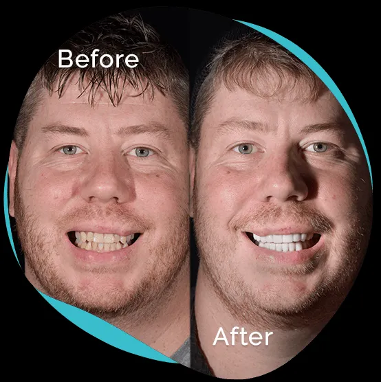 32286 teeth whitening aftercare