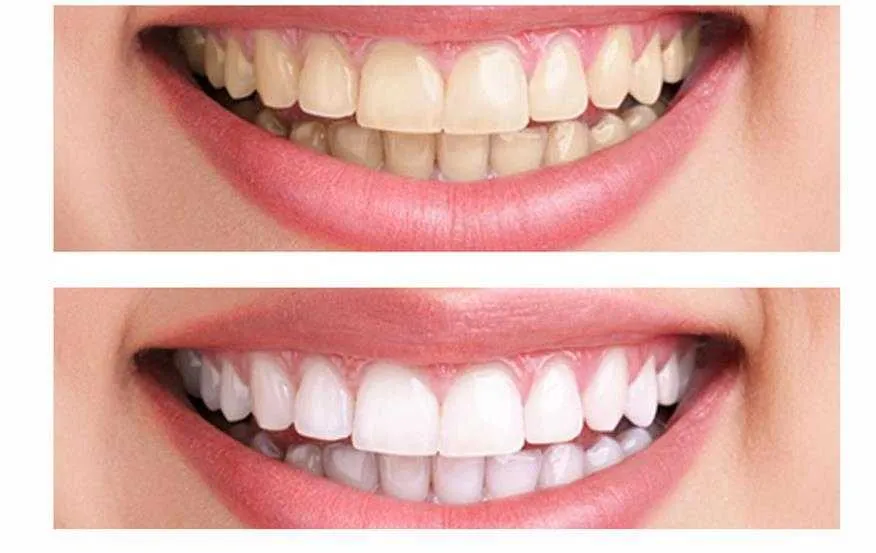 /img/32287-teeth-whitening-diet.webp