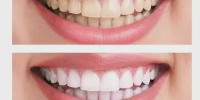 /img/32287-teeth-whitening-diet.webp