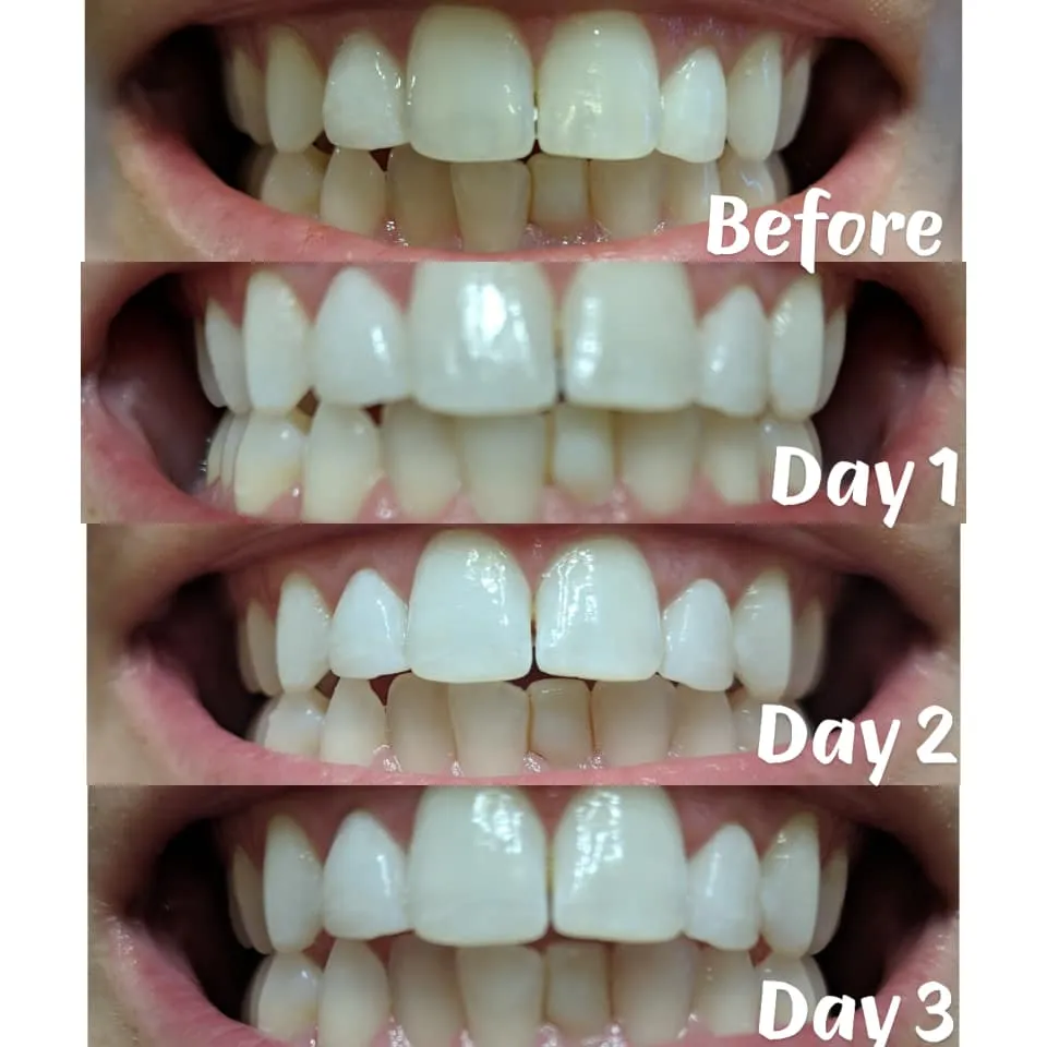 32289 teeth whitening sensitive teeth